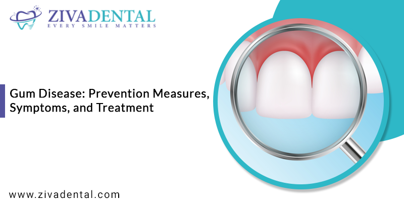 Gum Disease: Prevention Measures, Symptoms, and Treatment