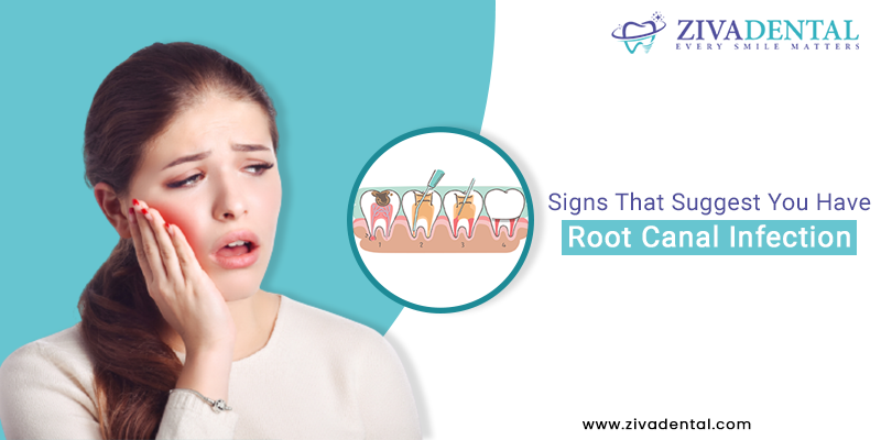 Signs That Suggest You Have Root Canal Infection