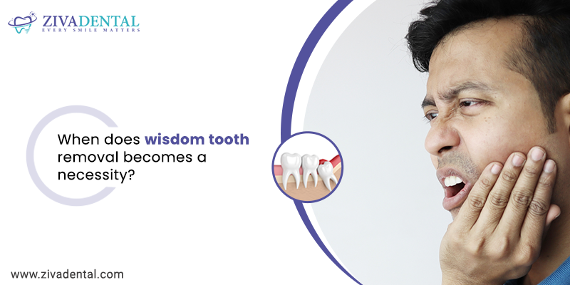 When Does Wisdom Teeth Removal Become a Necessity?