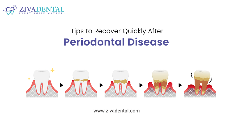 3 Tips to Recover Quickly After Periodontal Disease