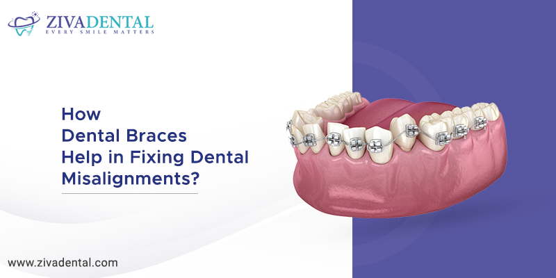 Dental Braces Help in Fixing Dental Misalignments