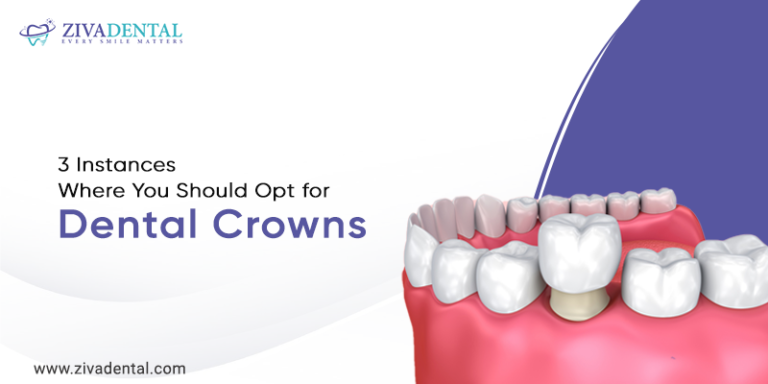 3 Instances Where You Should Opt for Dental Crowns - Ziva Dental